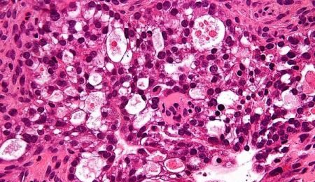 “Effetto domino” di radicali liberi contro le cellule tumorali