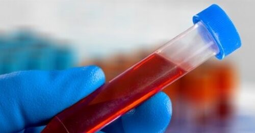 Albumina, la spia del sangue che predice il rischio di cancro e infarto negli anziani Nella ricerca sono state coinvolte circa 18.000 persone delle quali 3.299 di età pari o superiore ai 65 anni.