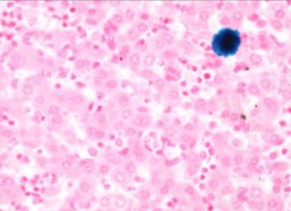 I tumori si nutrono di ferro attraverso un meccanismo neonatale